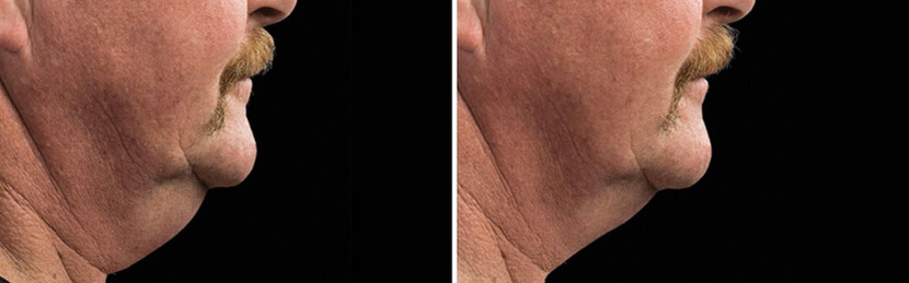 Cool sculpting results in man