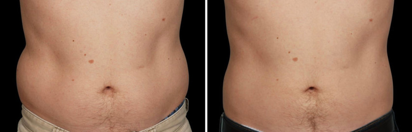 Cool sculpting results in man