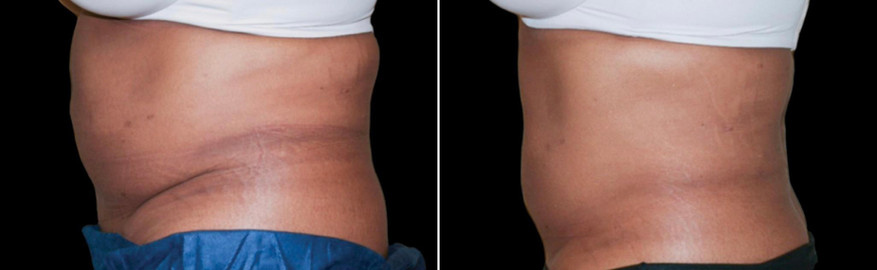 Cool sculpting results in woman