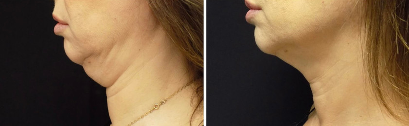 Cool sculpting results in woman