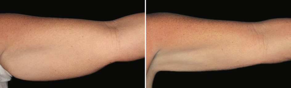 Cool sculpting results in woman