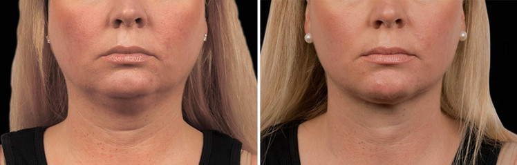 Cool sculpting results in woman