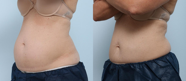 Cool sculpting results in woman