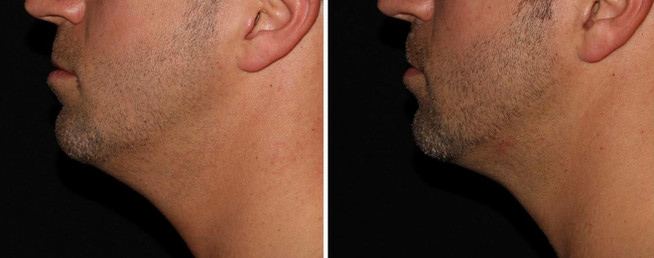 Cool sculpting results in man