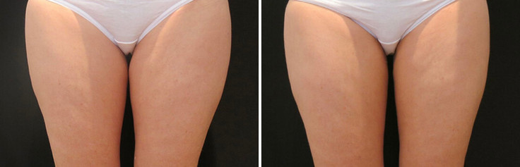 Cool sculpting results in woman