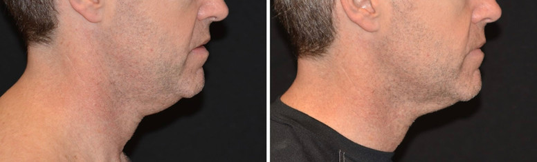 Cool sculpting results in man