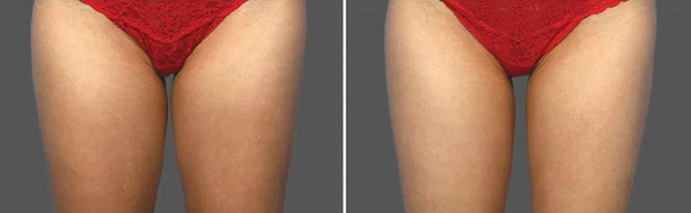 Cool sculpting results in woman