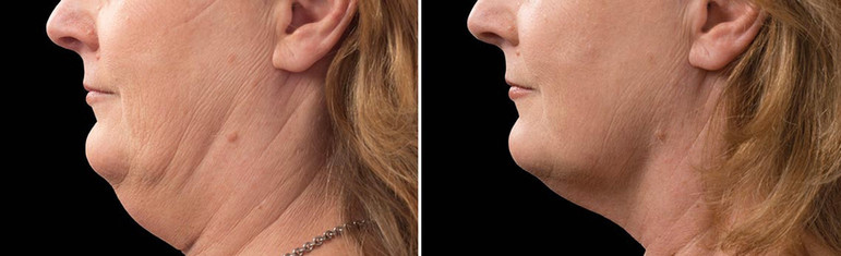 Cool sculpting results in woman