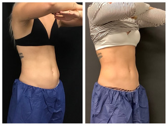 Cooltone results in woman