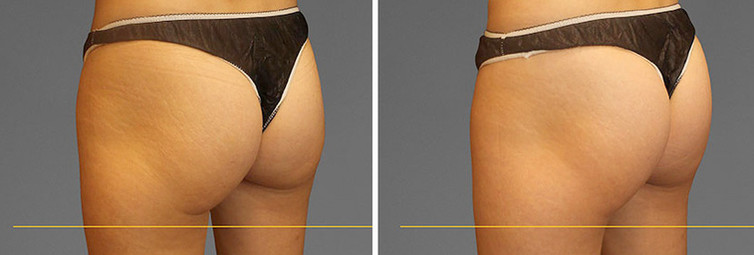 Cooltone results in woman