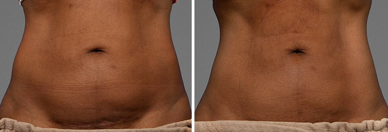 Cooltone results in woman