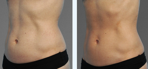 Cooltone results in woman
