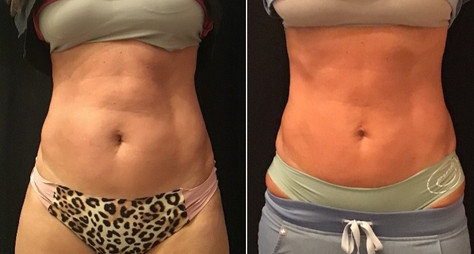 Cooltone results in woman