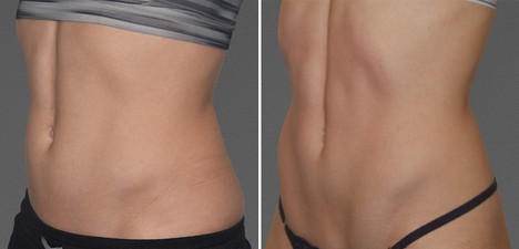 Cooltone results in woman
