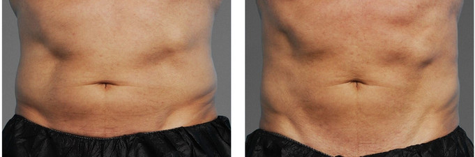 Cooltone results in man