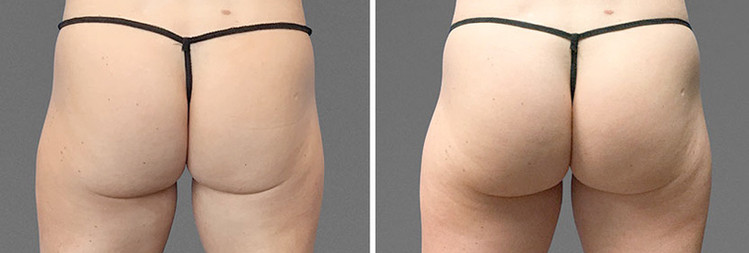 Cooltone results in woman