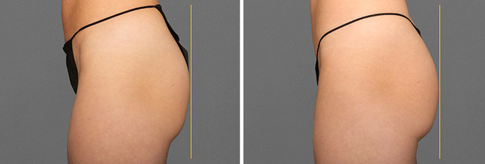 Cooltone results in woman
