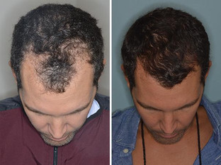 hair restoration in man