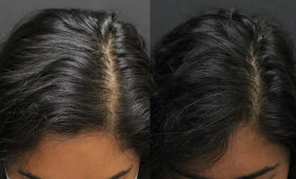 hair restoration woman