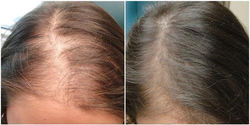 hair restoration in woman