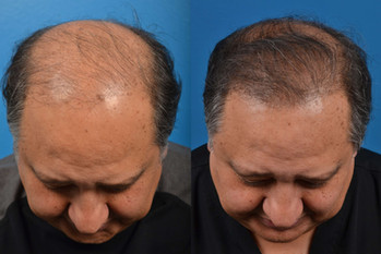 hair restoration in man