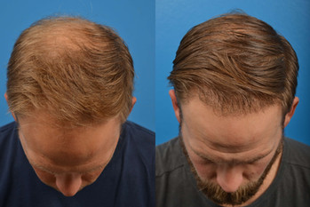 hair restoration man
