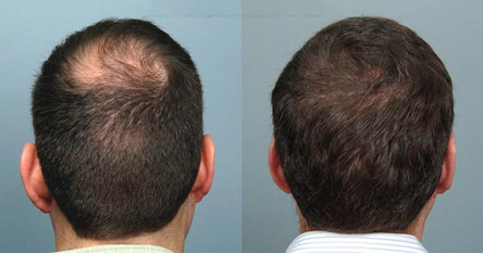 hair restoration in man