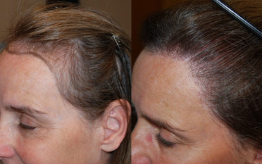hair restoration in woman