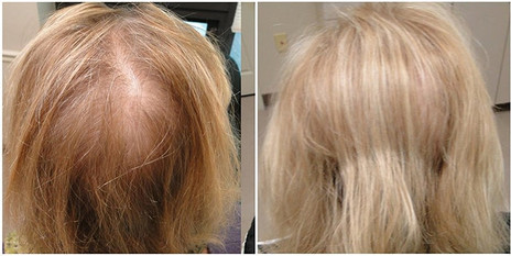 hair restoration in woman