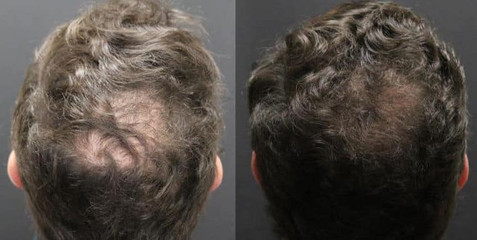 hair restoration in man