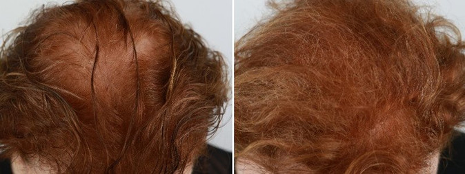 hair restoration in woman