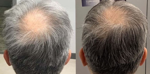 hair restoration in man