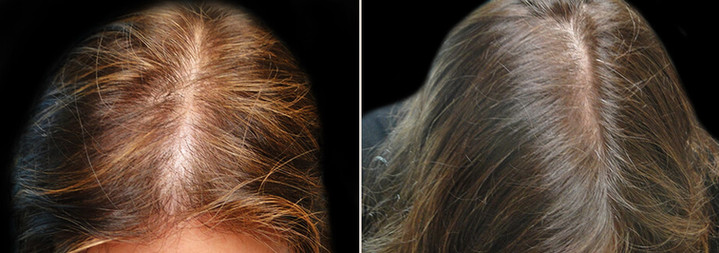 hair restoration in woman