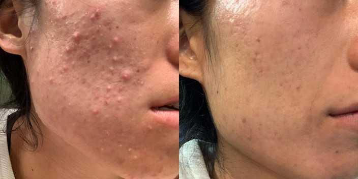Hydrafacial results young woman