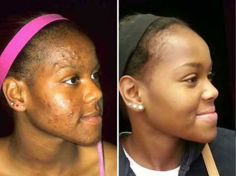 Hydrafacial results young woman
