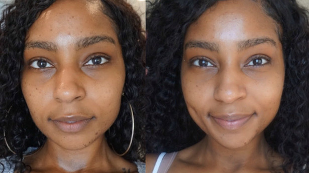 Hydrafacial results young woman