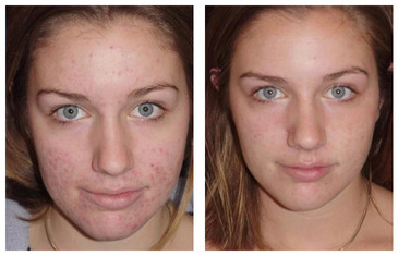 Hydrafacial results young woman