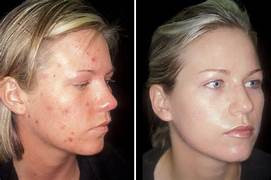 Hydrafacial results young woman