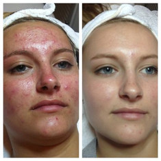 Hydrafacial results young woman