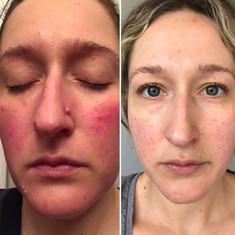 Hydrafacial results young woman