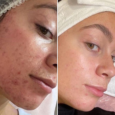 Hydrafacial results young woman