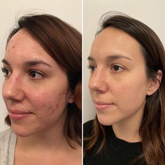 Hydrafacial results young woman
