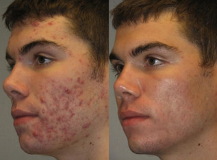 Hydrafacial results young man