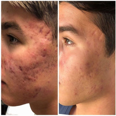 Hydrafacial results young man