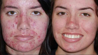 Hydrafacial results young woman