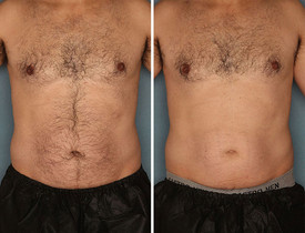 Laser hair removal chest