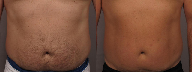 Laser hair removal stomach