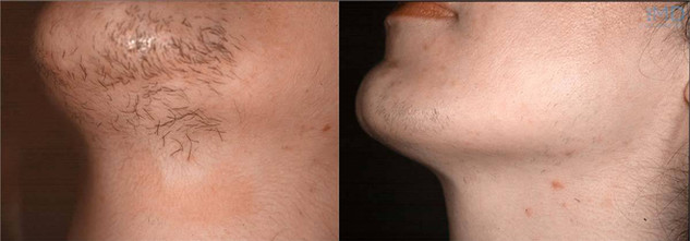 Laser hair removal chin