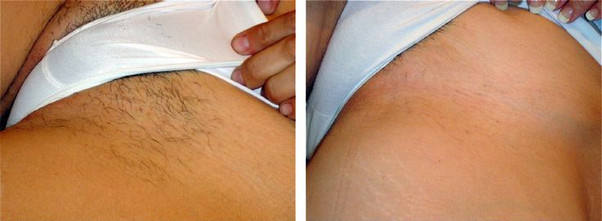 Laser hair removal pubic area