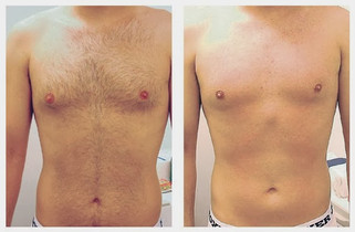 Laser hair removal chest
